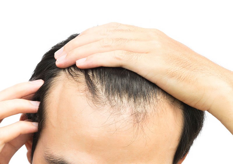 Saiba Diferenciar A Calv cie Masculina Da Queda De Cabelo